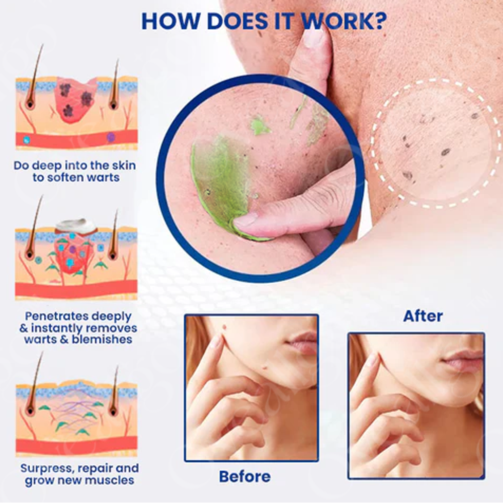✅ Official Store: Oveallgo® NatureErase Instant Mole & Spot Removal Gel