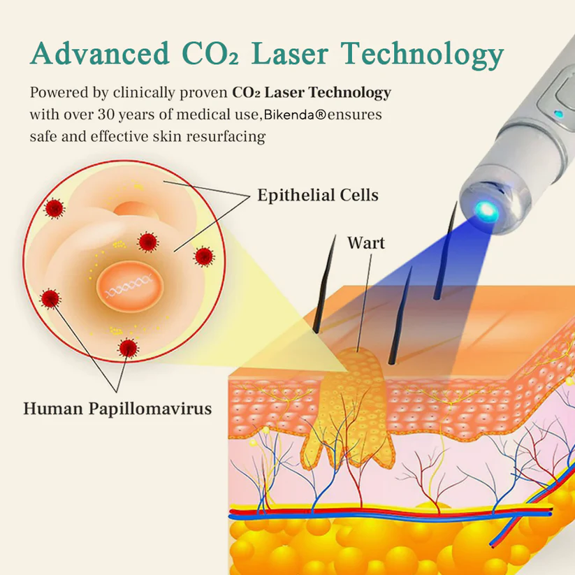 Bikenda® HPV Genital Warts Removal Laser Pen