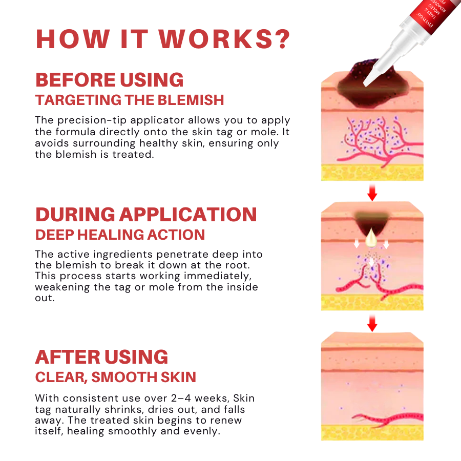 Fivfivgo® PRO Tags & Moles Remover Pen