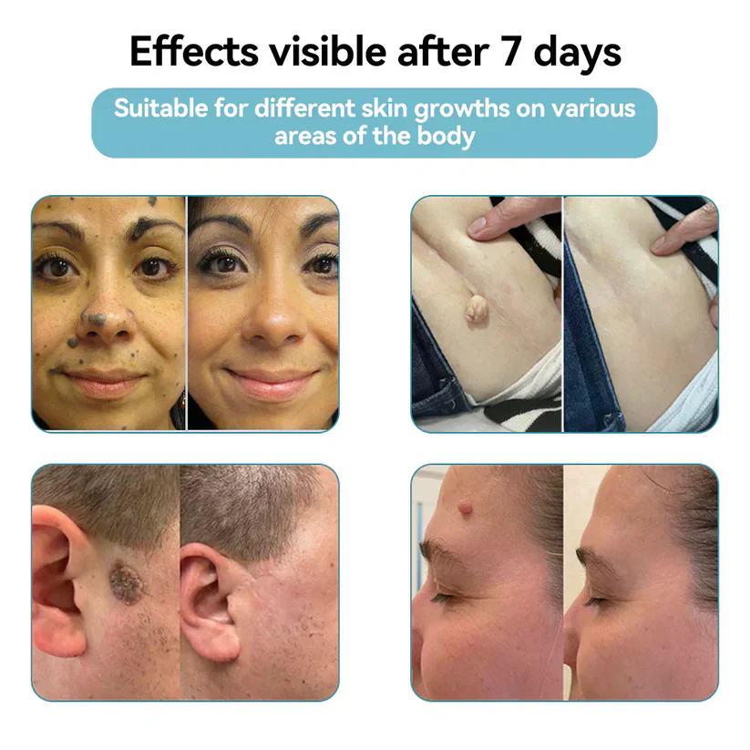 Bikenda® All-in-One CO₂ Laser Eraser Pen | Removes Moles, Warts, Skin Flaws & Pigmentation