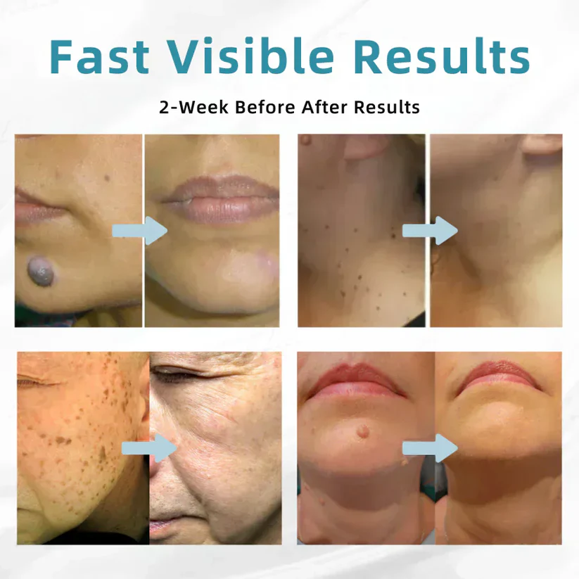 Bikenda® All-in-One CO₂ Laser Eraser Pen | Removes Moles, Warts, Skin Flaws & Pigmentation