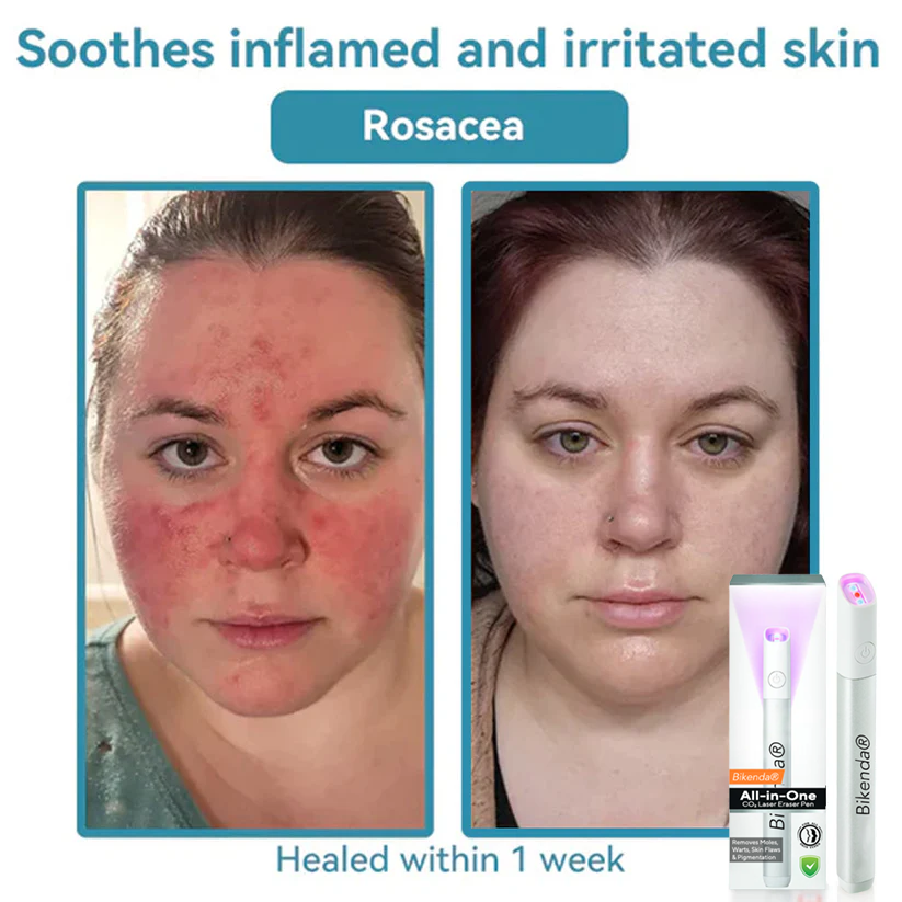 Bikenda® All-in-One CO₂ Laser Eraser Pen | Removes Moles, Warts, Skin Flaws & Pigmentation