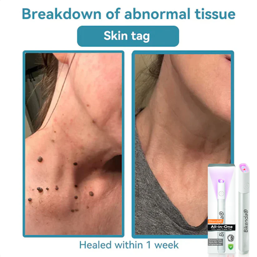Bikenda® All-in-One CO₂ Laser Eraser Pen | Removes Moles, Warts, Skin Flaws & Pigmentation