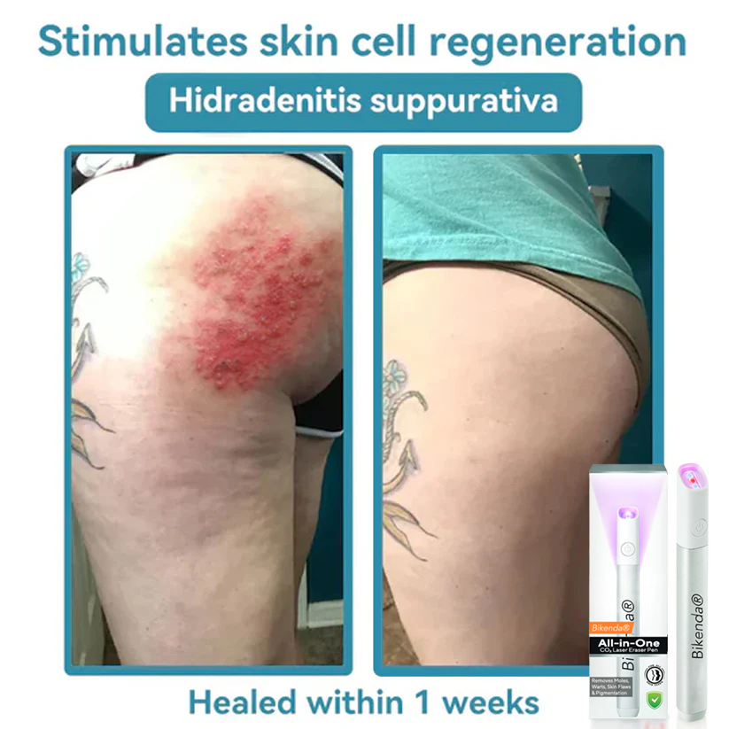 Bikenda® All-in-One CO₂ Laser Eraser Pen | Removes Moles, Warts, Skin Flaws & Pigmentation