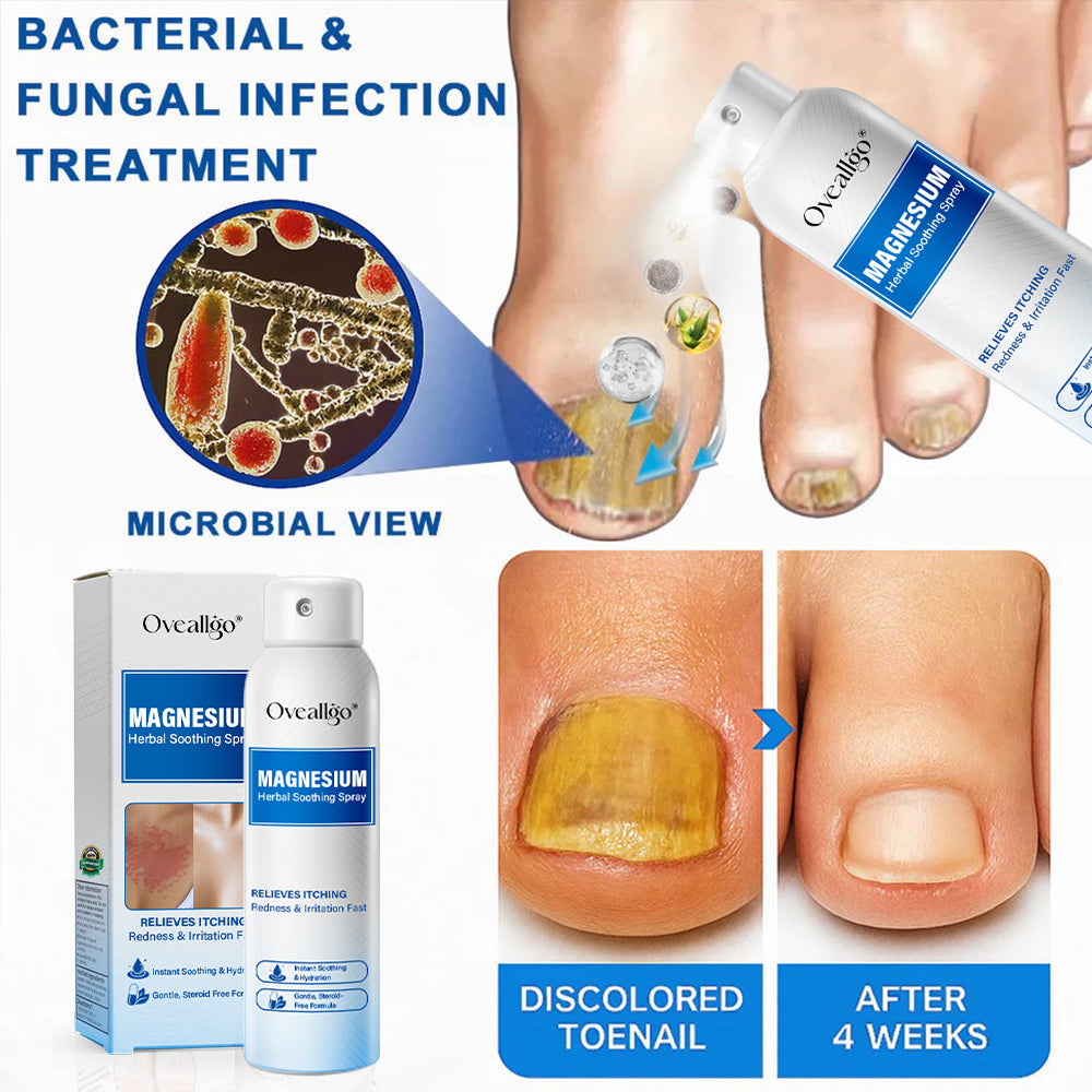 Oveallgo® Magnesium PRO Herbal Psoriasis Spray