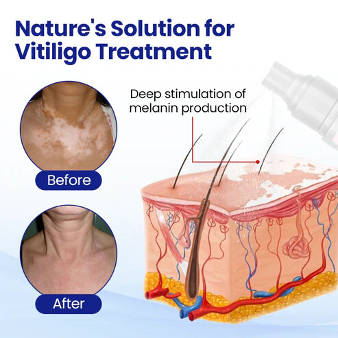 Oveallgo® Evenora Herbal Spray Pro
