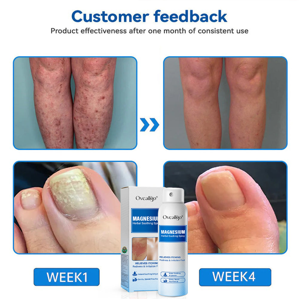 Oveallgo® Magnesium PRO Herbal Psoriasis Spray
