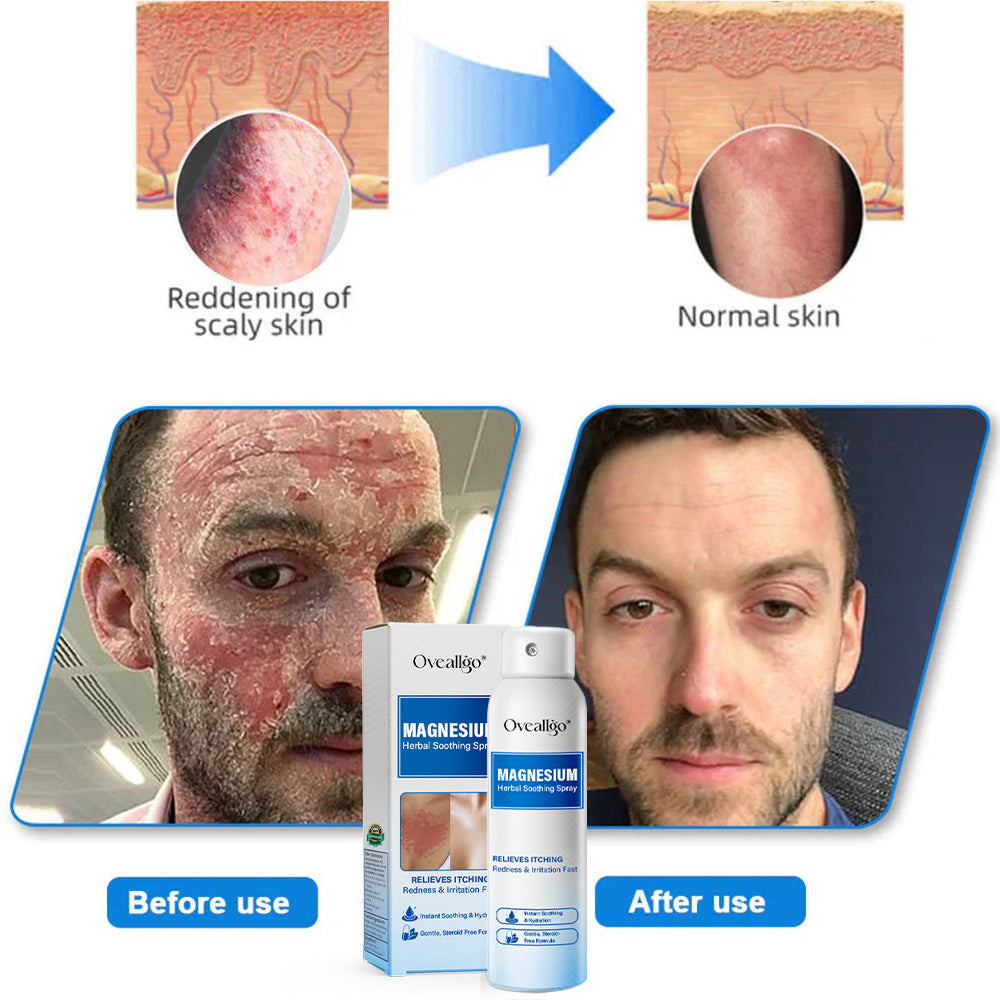 Oveallgo® Magnesium PRO Herbal Psoriasis Spray