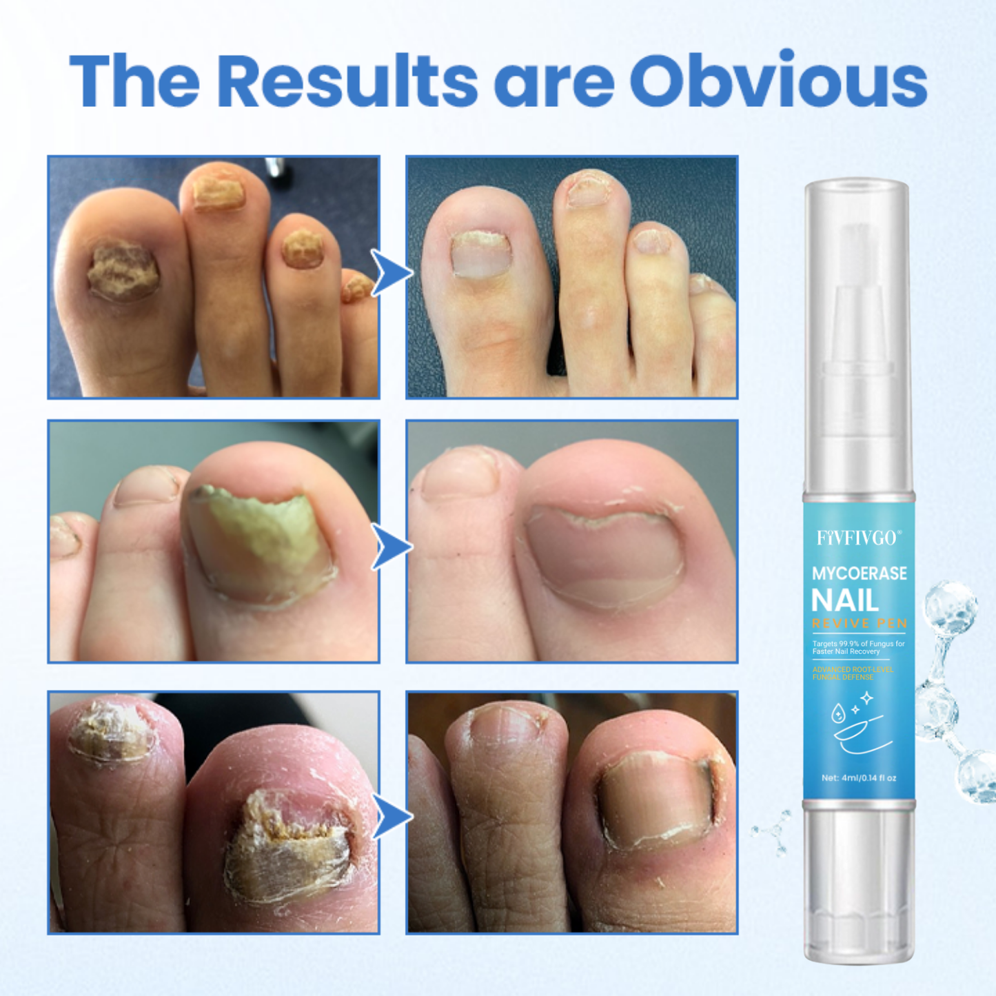 Fivfivgo® MycoErase PRO Nail Revive Pen