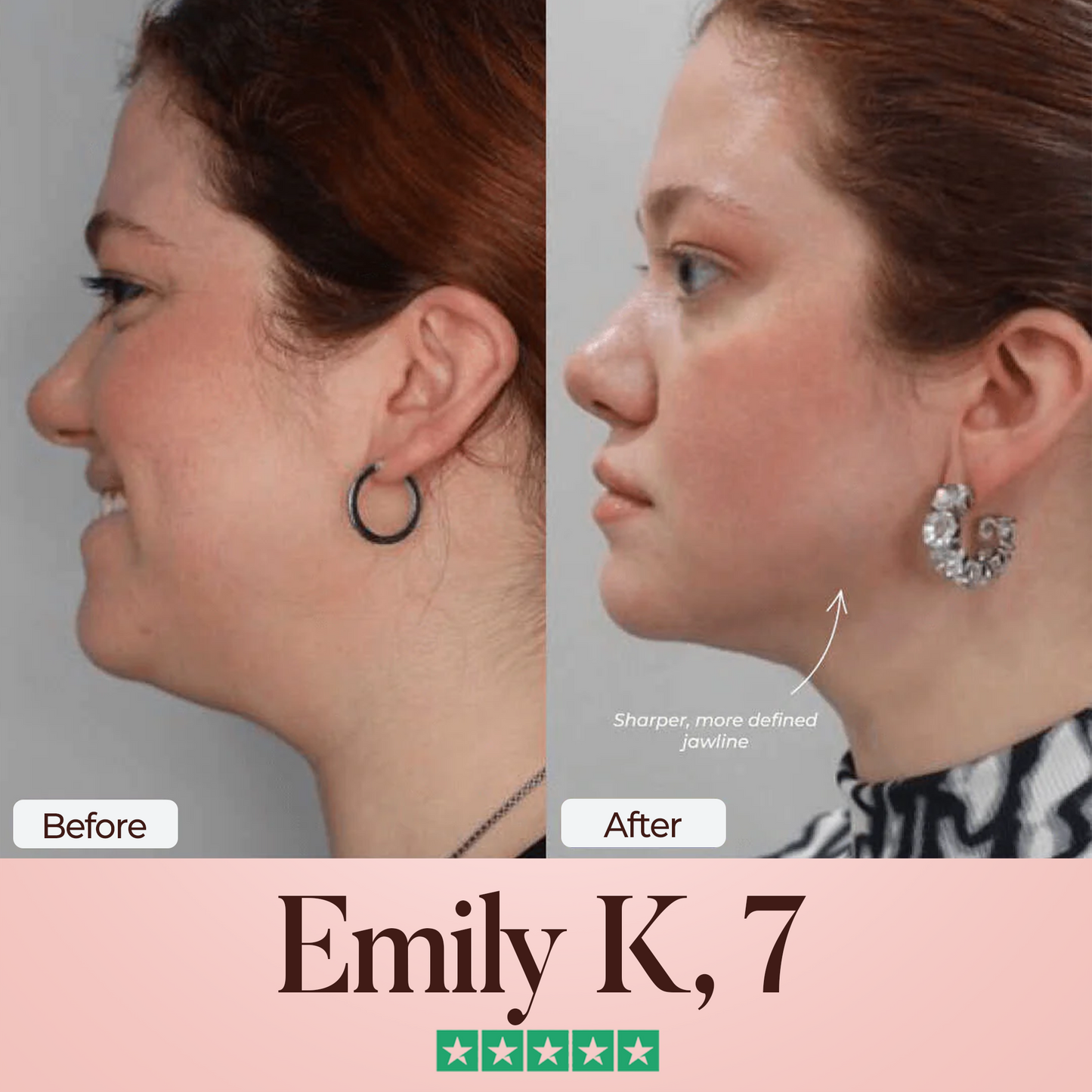 Oveallgo® SculptFix Mask Infused with Retinol & Collagen to Reveal Your Best Jawline