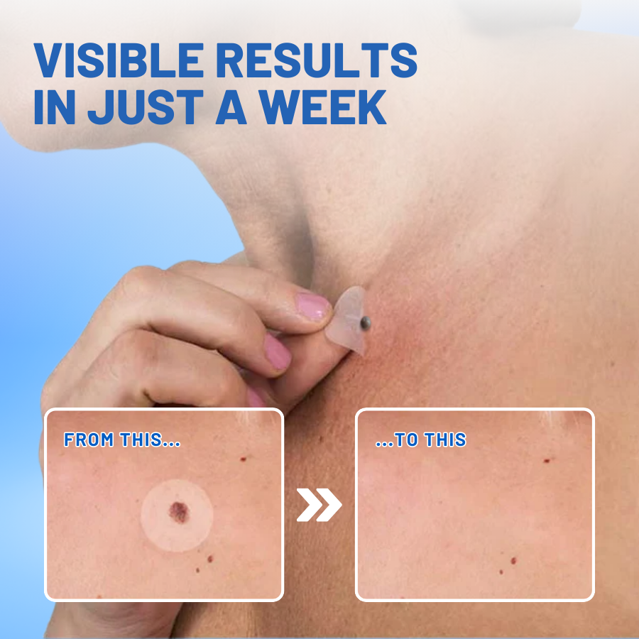 Fivfivgo® Advanced Moles & Warts Removing Skin Tag Patch
