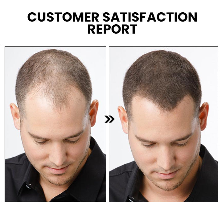 ✅Official Store: Oveallgo™ New ShougaGRO Japanese Hair Growth Spray👨⚕️Endorsed by AHLA (Clinically proven to promote hair regrowth, strengthen follicles, improve scalp health, and combat hair thinning)