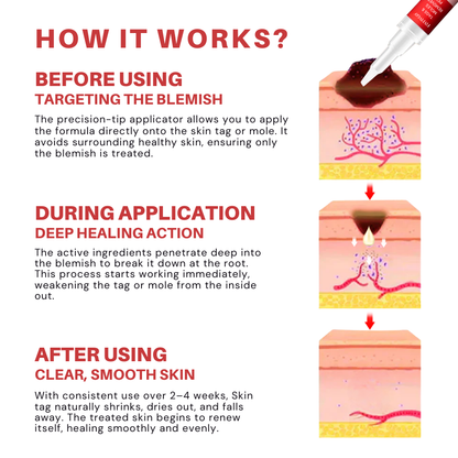 Fivfivgo® PRO Tags & Moles Remover Pen