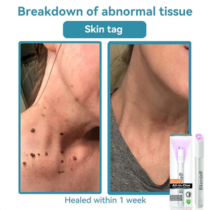 Bikenda® All-in-One CO₂ Laser Eraser Pen | Removes Moles, Warts, Skin Flaws & Pigmentation