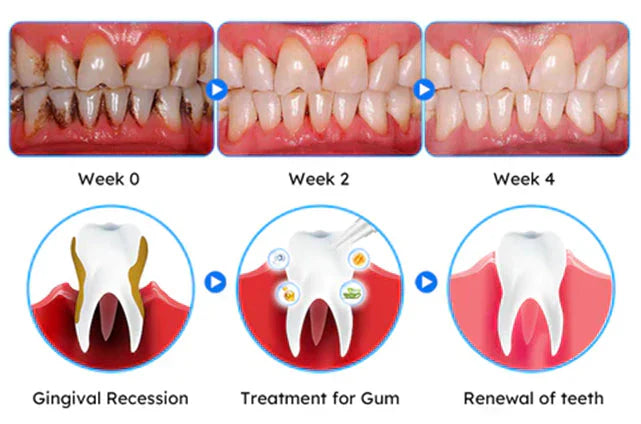 Oveallgo® ULTRA Gum Care Gel – Restore & Strengthen Your Gums