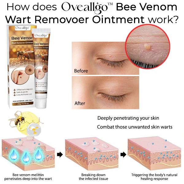 Oveallgo™ Bee Venom Wart Remover Ointment