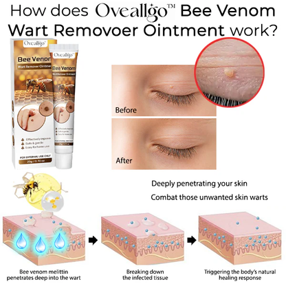 Oveallgo™ Bee Venom Wart Remover Ointment